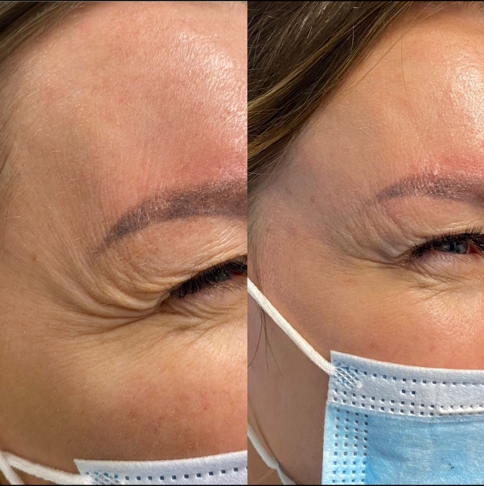 Before and after crow’s-feet