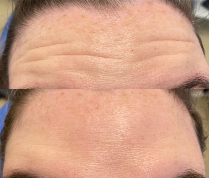 Before and after forehead lines · case 02