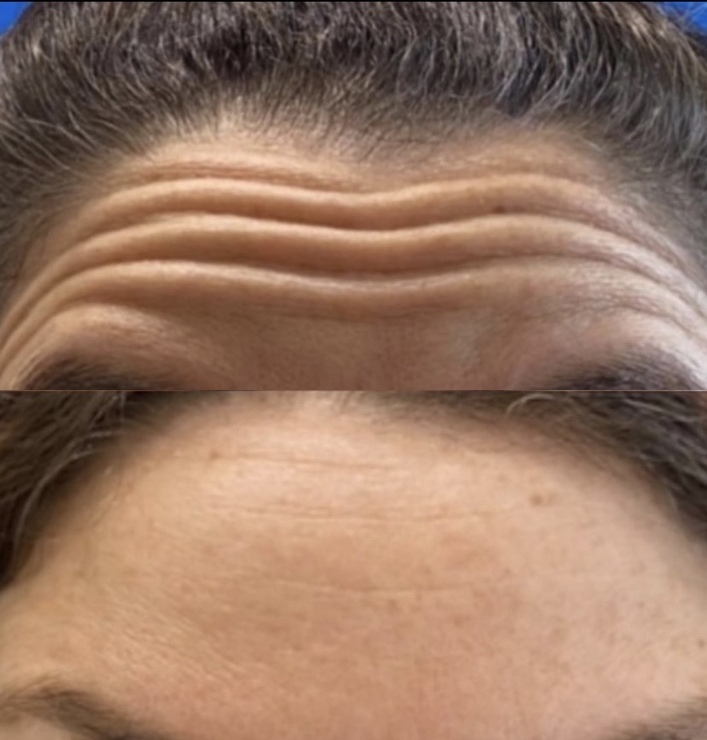 Before and after forehead lines · case 03