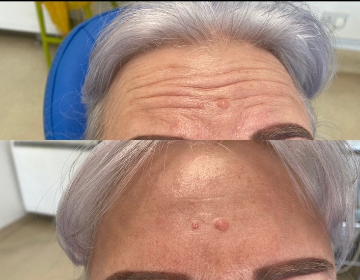 Before and after forehead lines · case 04