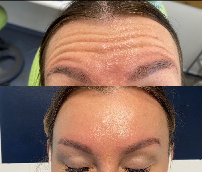 Before and after forehead lines