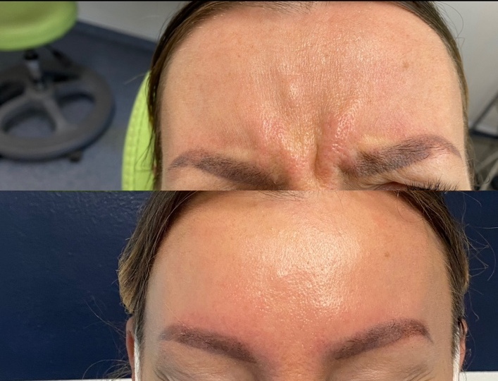 Before and after frown lines