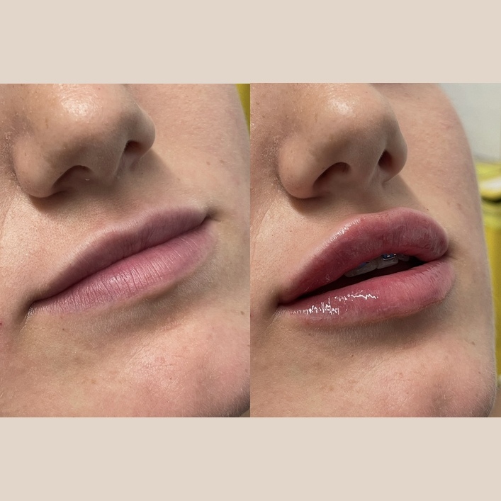 Before and after lip enhancement