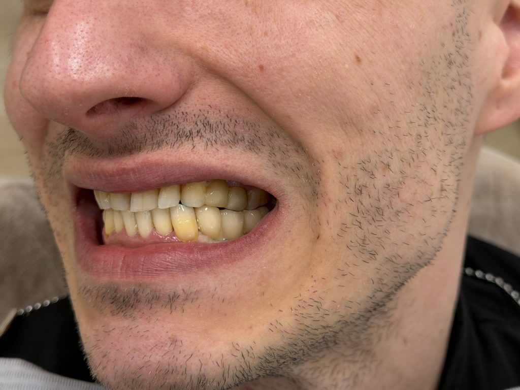 Implant crowns — final result